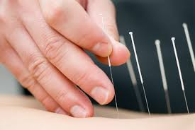 acupuncture -centenary-physio
